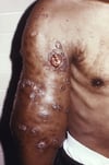 Micetoma actinomicótico