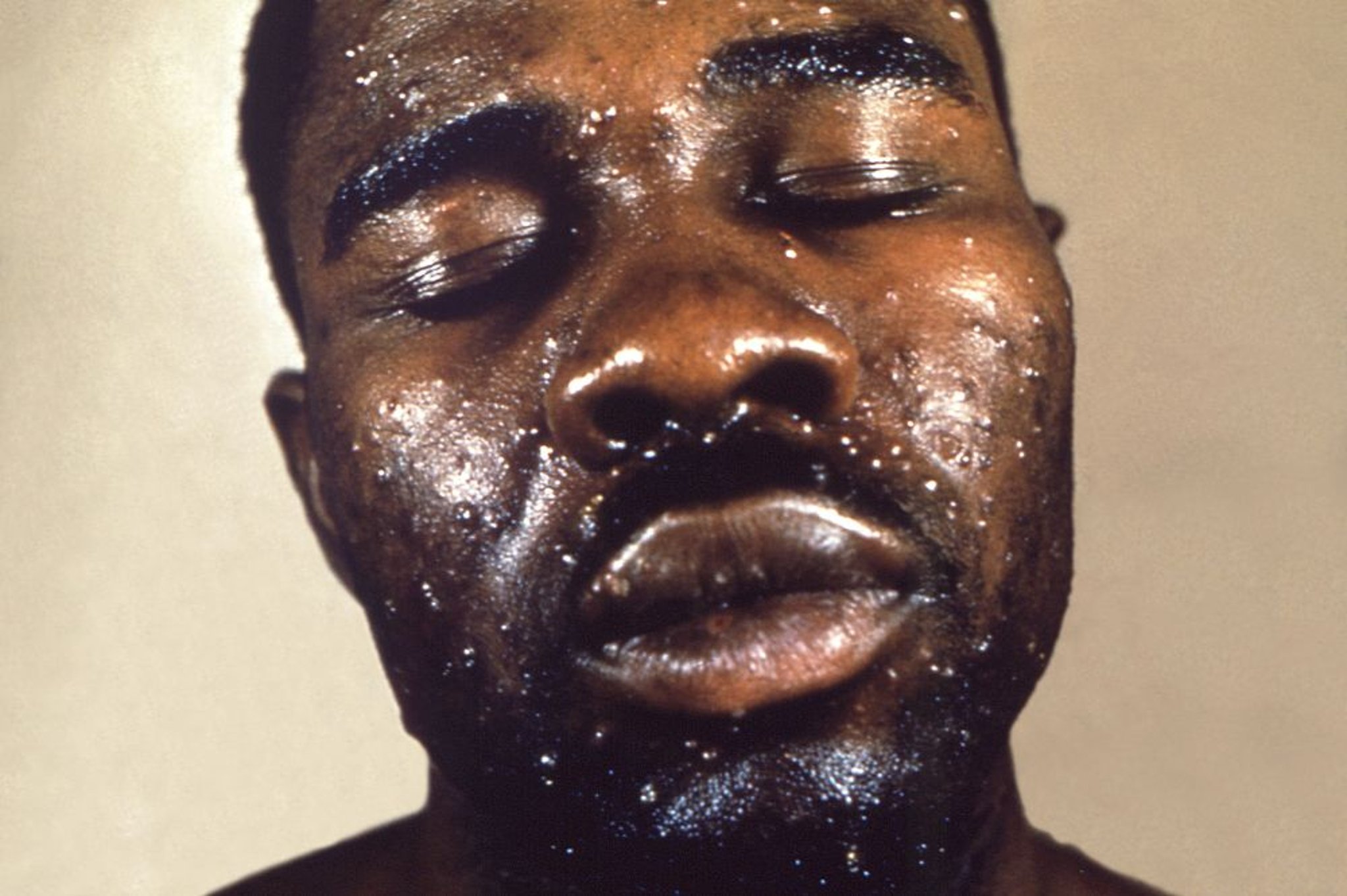 Windpocken (Gesicht)