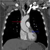 CTA (koronale Ansicht) des Thorax mit Darstellung der aufsteigenden thorakalen Aorta