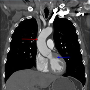 Angiografía por TC (vista coronal) torácica que muestra la aorta torácica ascendente