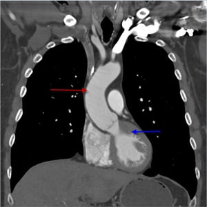 Angio-TDM (vue coronale) du thorax montrant l'aorte thoracique ascendante