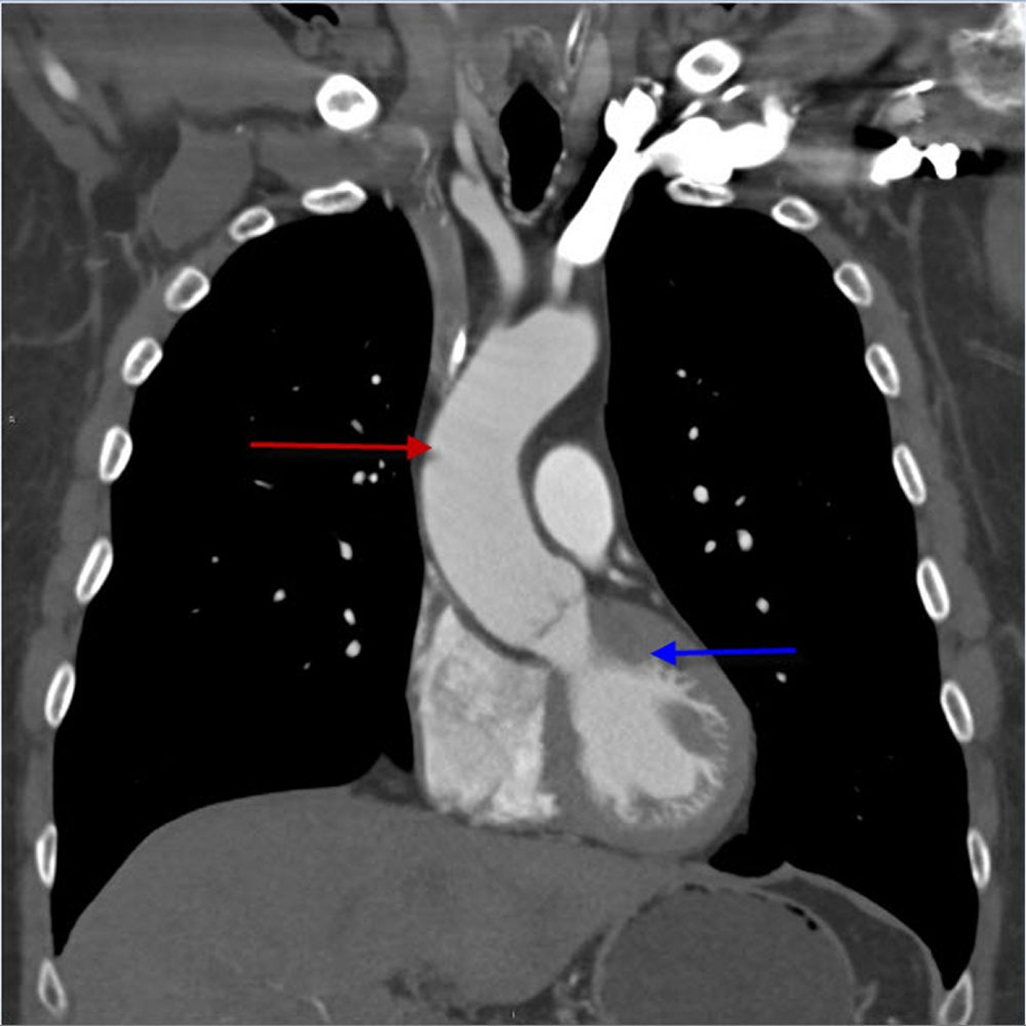 ATC (incidência coronal) do tórax mostrando a aorta torácica ascendente