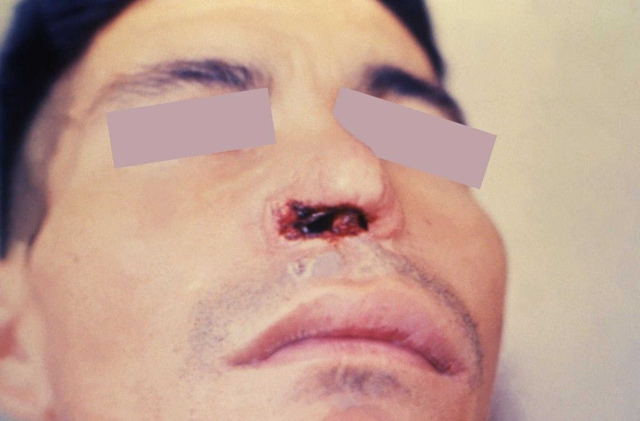 Bệnh do leishmania niêm mạc