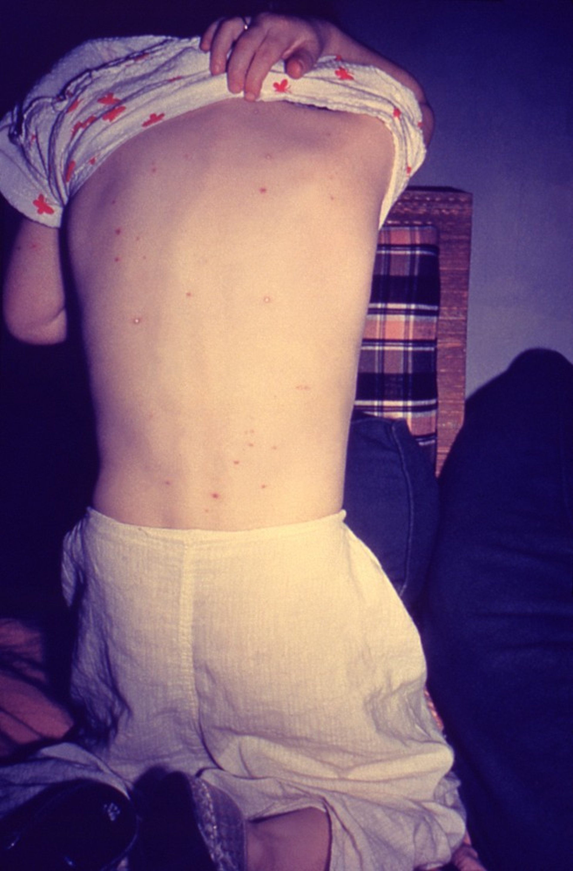 Chickenpox (Back)