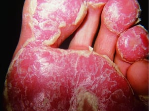 膿漏性角化症（足底）