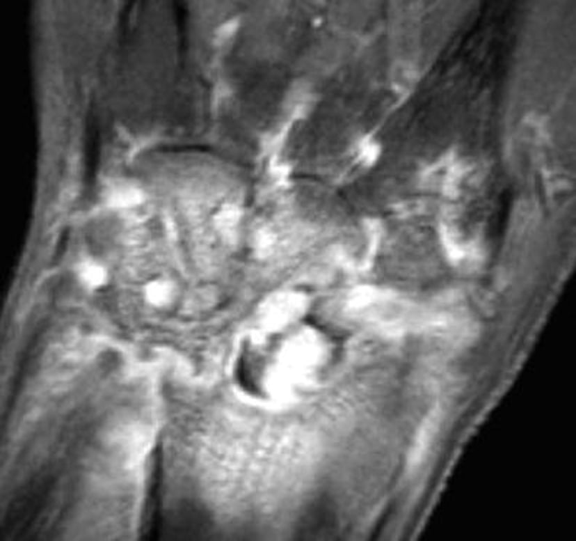 手関節における淋菌性関節炎のMRI
