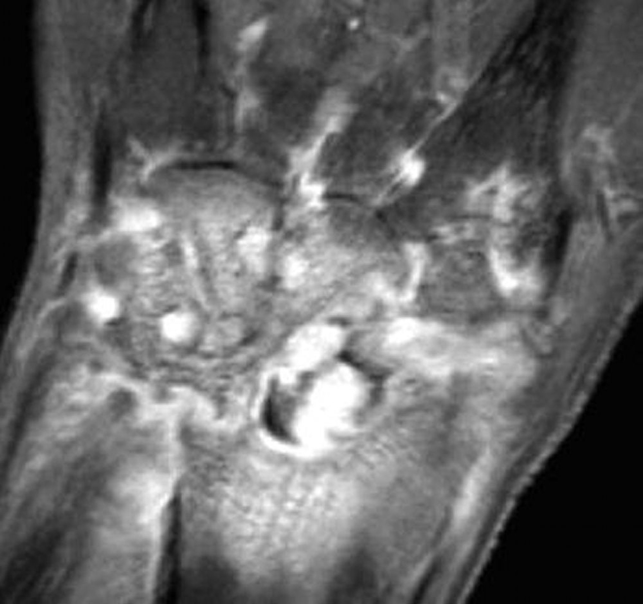 MRI Viêm khớp cổ tay do lậu cầu