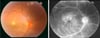 Eye Findings in Behçet Disease
