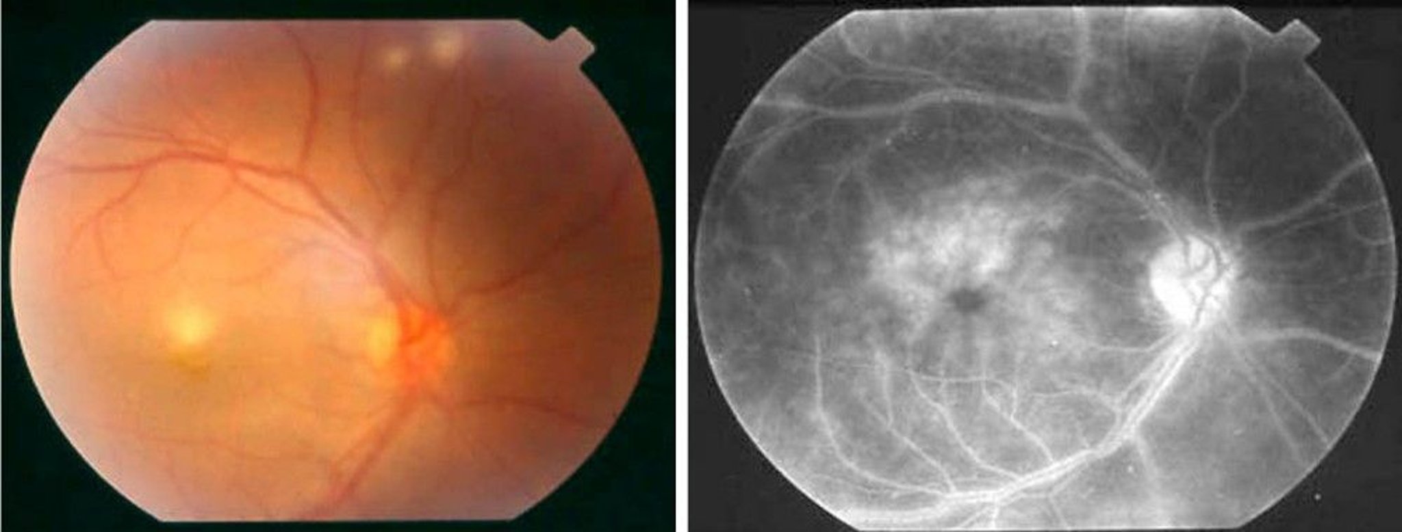 Eye Findings in Behçet Disease