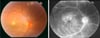 Signes oculaires dans la maladie de Behçet