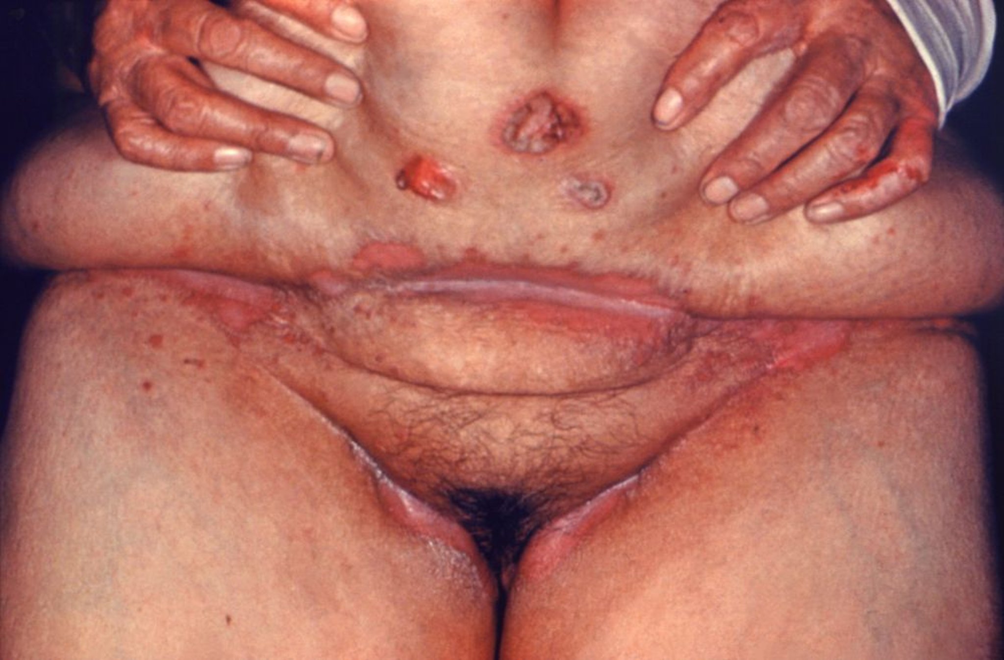 Infección por candidiasis de las áreas intertriginosas del abdomen y la ingle