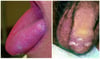 Oral and Genital Lesions in Behçet Disease