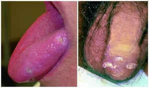 Lesiones bucales y genitales en la enfermedad de Behçet