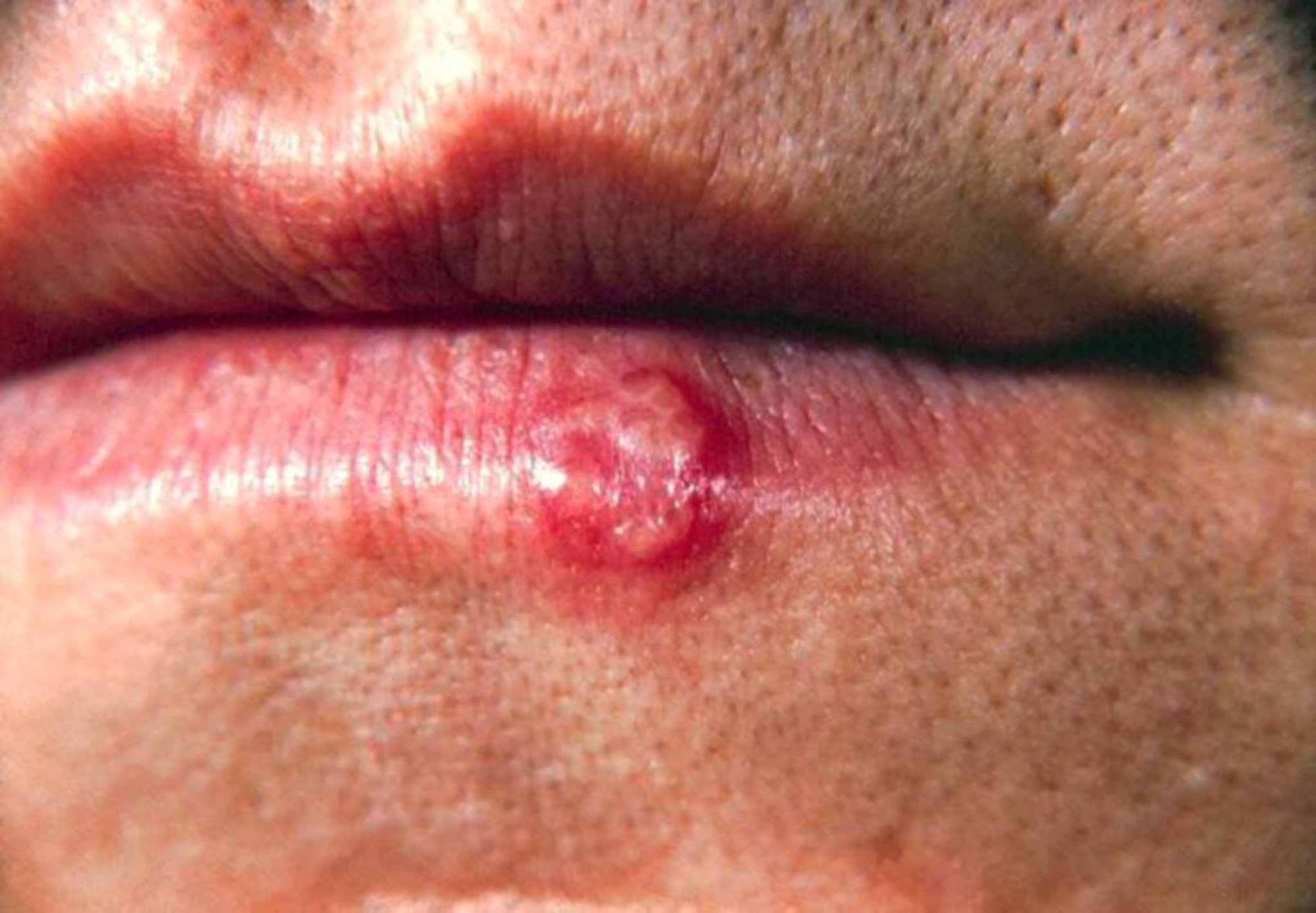 Herpès labial (lèvre)