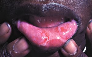 Malattia di Behçet (lesioni orali)