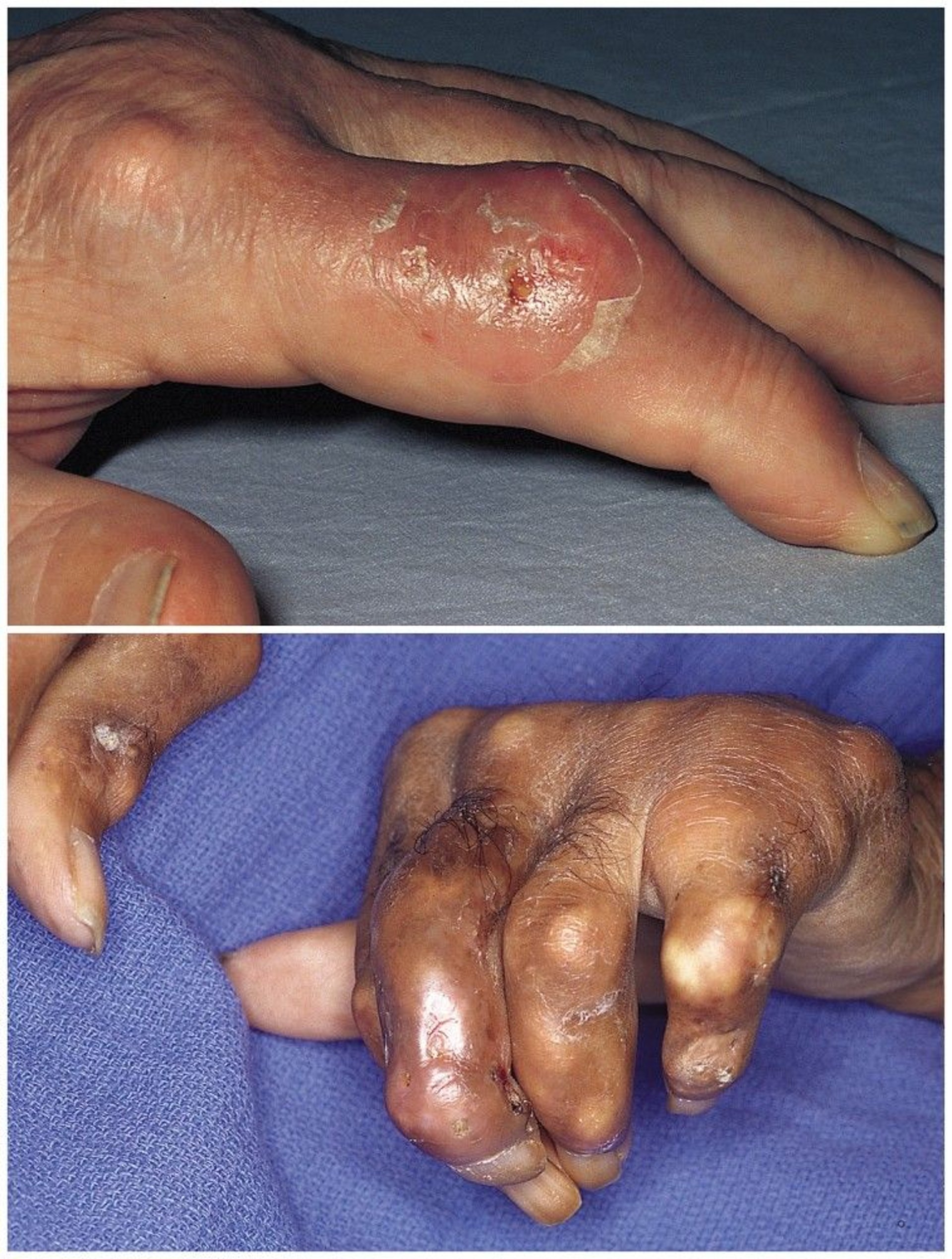 Tophaceous Gout in Fingers
