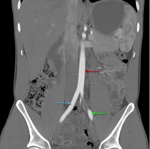 Angio-TDM (vue coronale) de l'abdomen montrant l'aorte abdominale