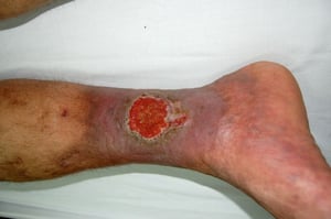 Large Venous Stasis Ulcer
