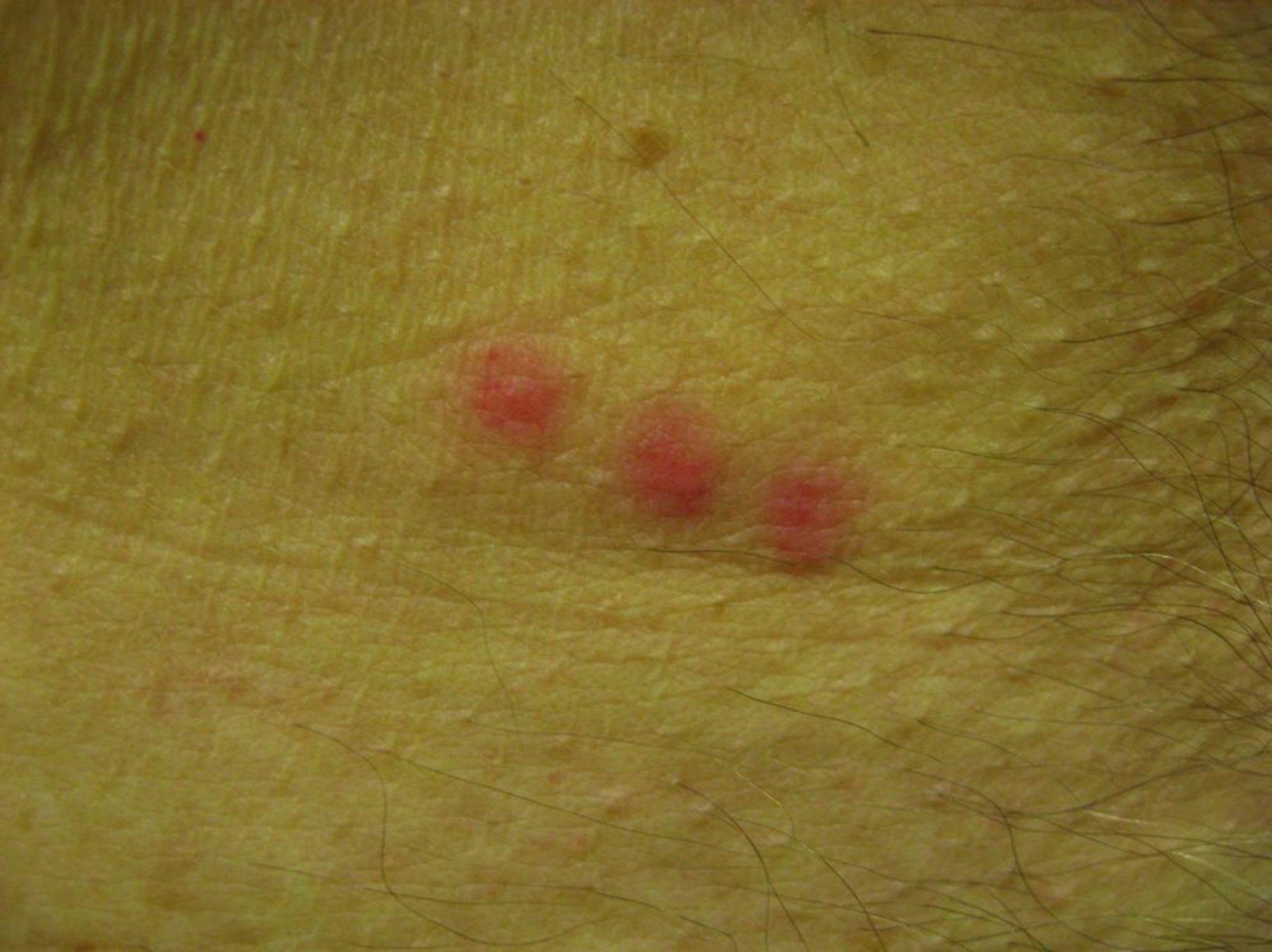 Bedbug Bites