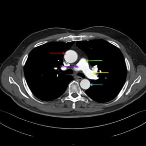 TC del torace che mostra l'anatomia dell'aorta e dell'arteria polmonare