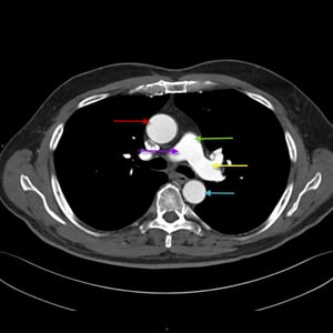 大動脈と肺動脈の構造を示した胸部CT画像