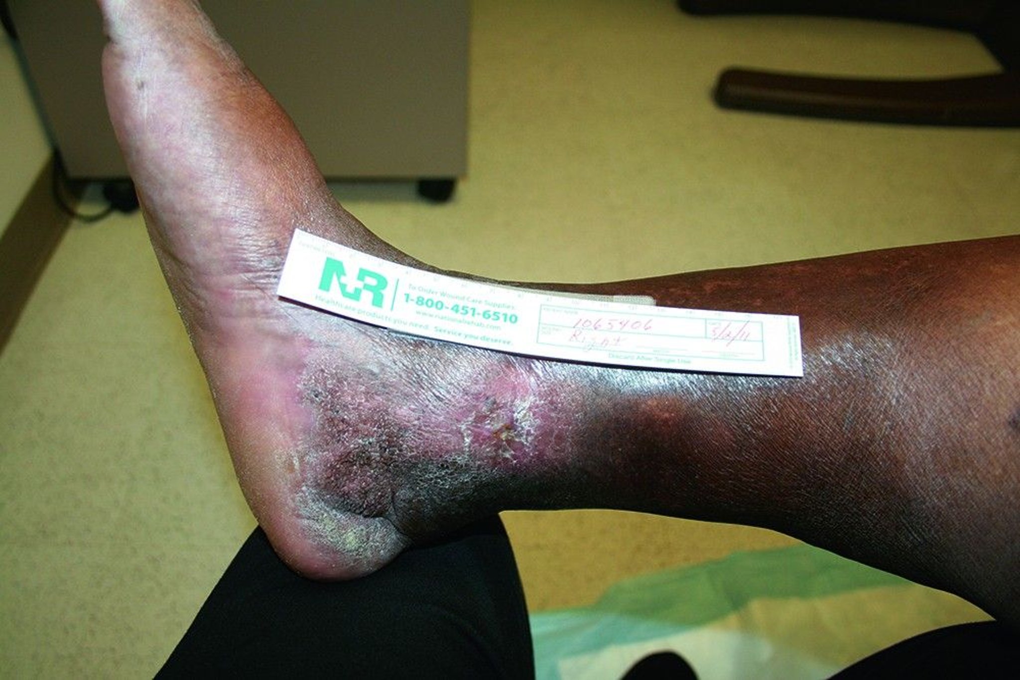 Early Venous Stasis Ulcer