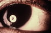Xeroftalmia