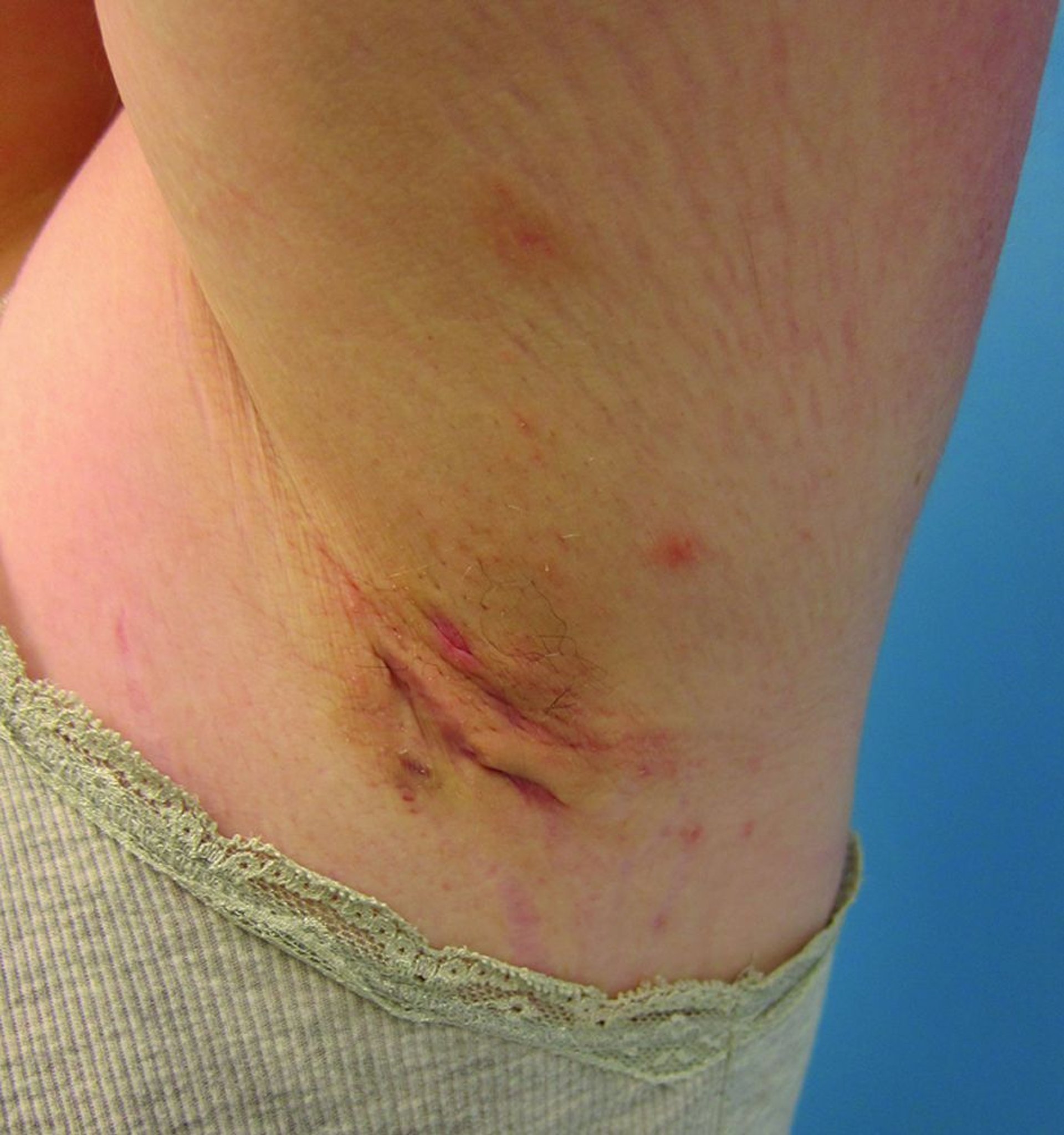 Hidradenitis supurativa (estadio de Hurley II)