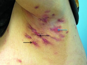 Hidradenitis suppurativa (Hurley-Stadium III)