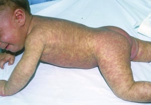 Urticaria pigmentosa (infante)