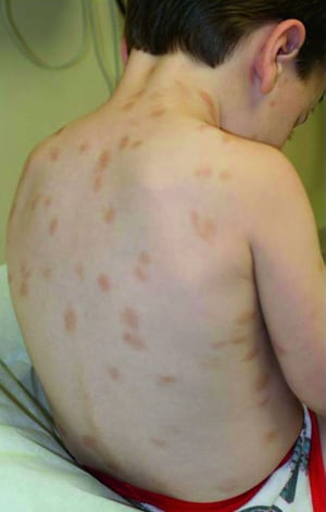 色素性蕁麻疹（小児）