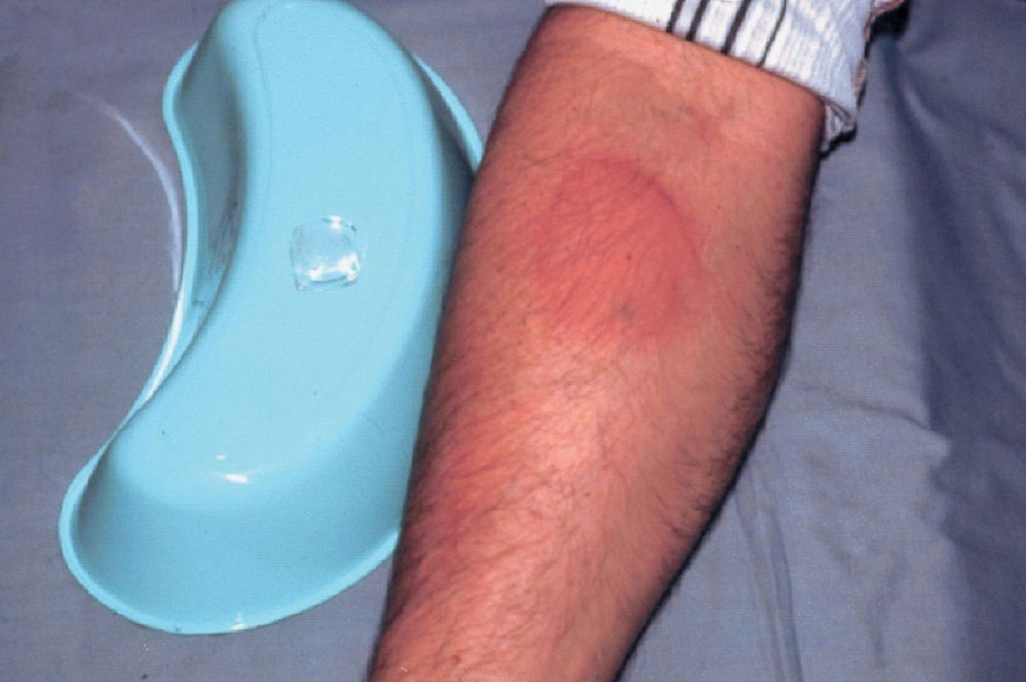 Kälteinduzierte Urtikaria