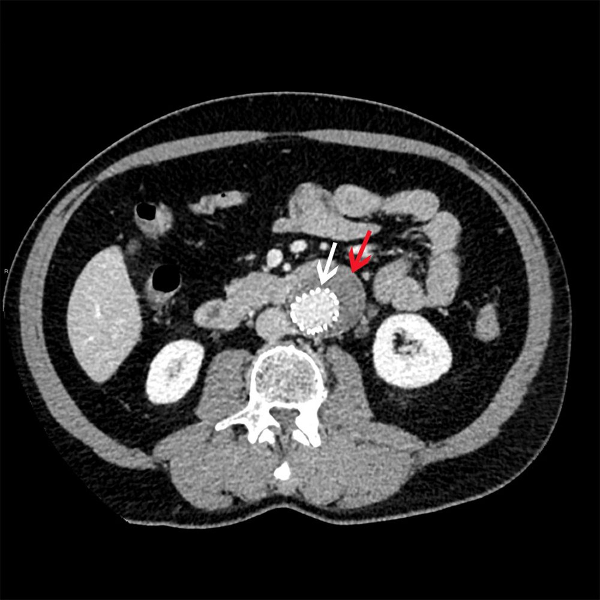 Endovaskulärer Stentgraft