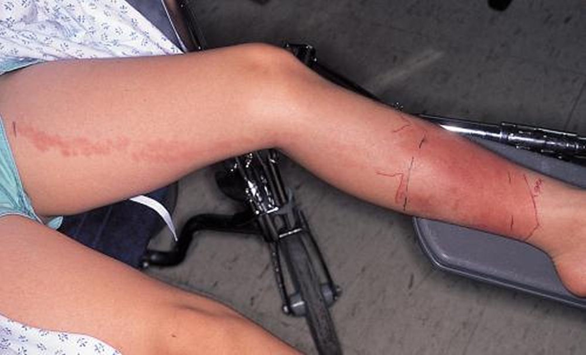 Cellulite streptococcique avec lymphangite d'accompagnement