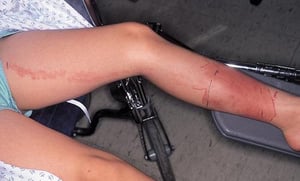 Streptococcal Cellulitis with Accompanying Lymphangitis