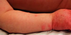 蕁麻疹と水疱性類天疱瘡