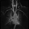 Ramas de aorta torácica ascendente en un paciente con arteritis de Takayasu