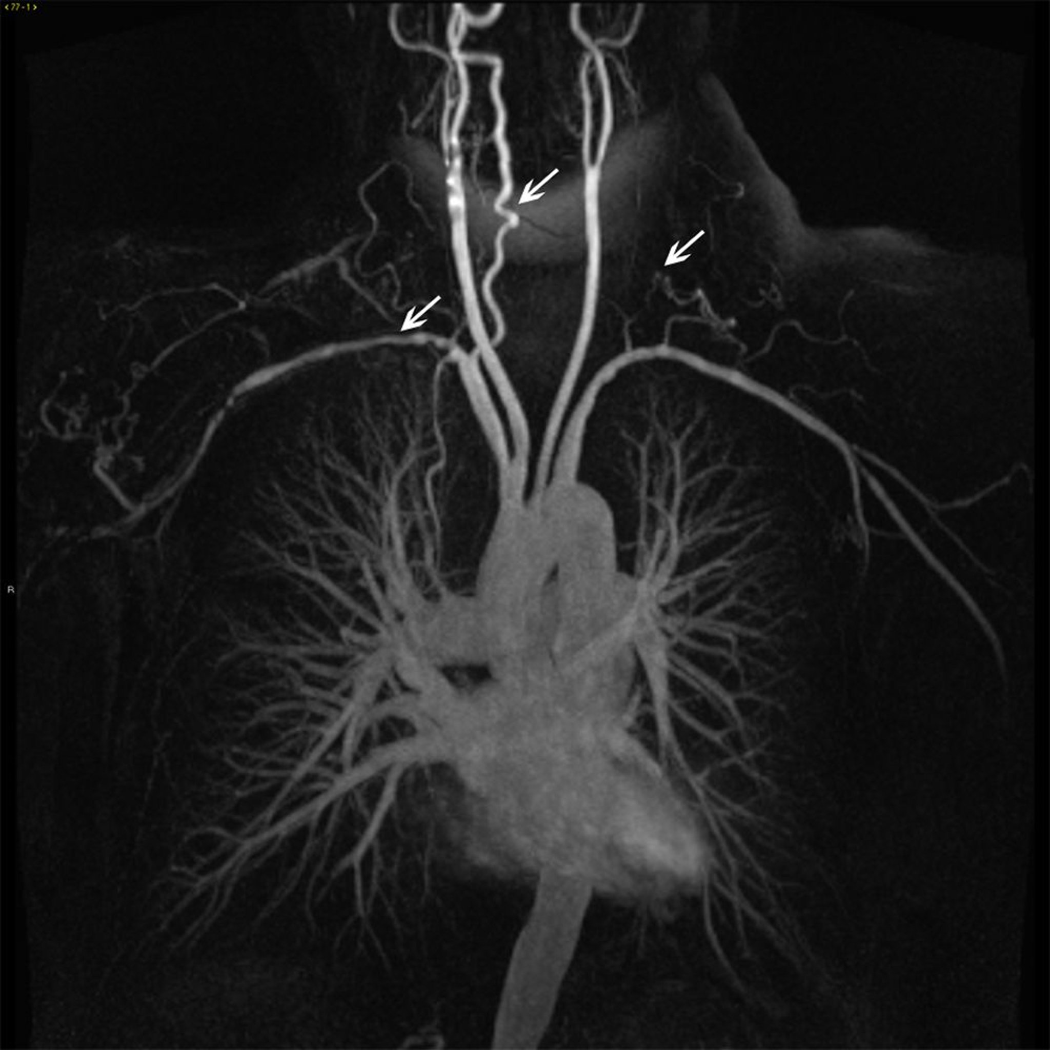 Branches de l'aorte thoracique ascendante chez un patient atteint d'artérite de Takayasu