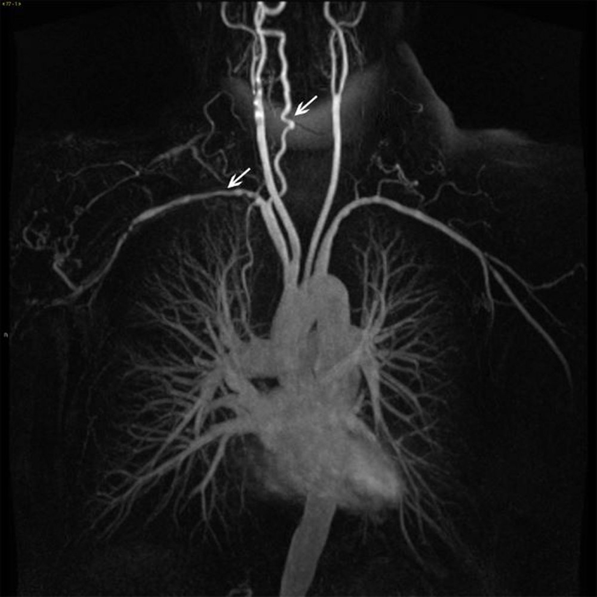Ramos da aorta torácica ascendente em um paciente com arterite de Takayasu