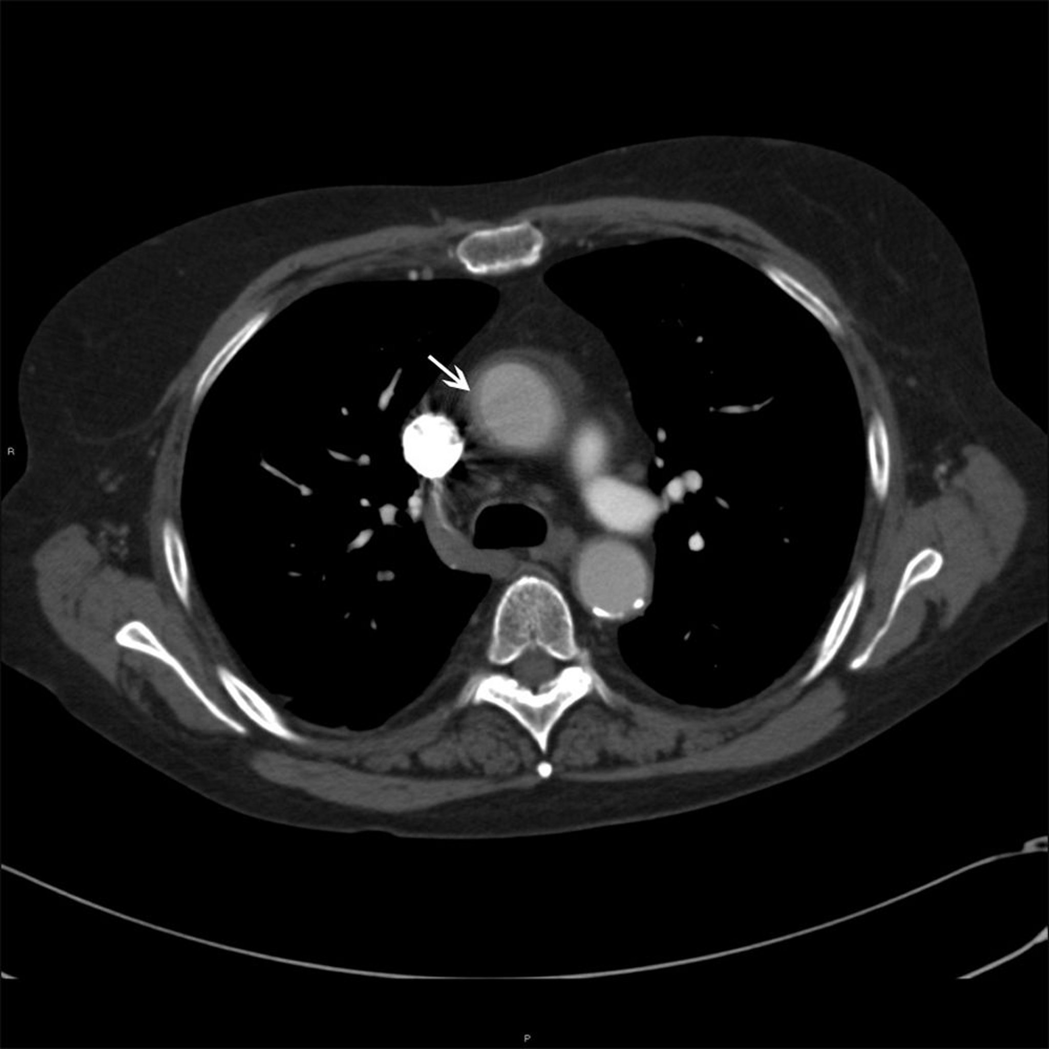 Ascending Aorta in Patient with Takayasu Arteritis