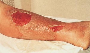 Streptococcal Cellulitis with Accompanying Tissue Necrosis