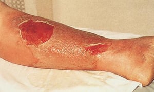 Streptococcal Cellulitis with Accompanying Tissue Necrosis