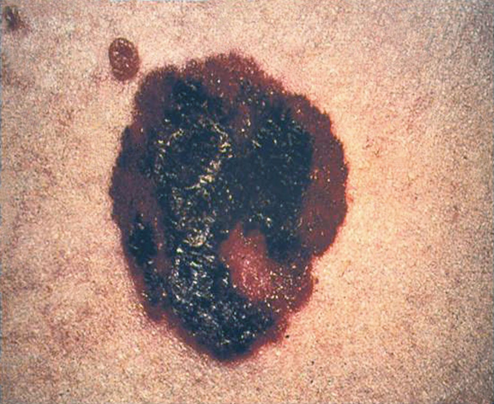 Nodular Melanoma