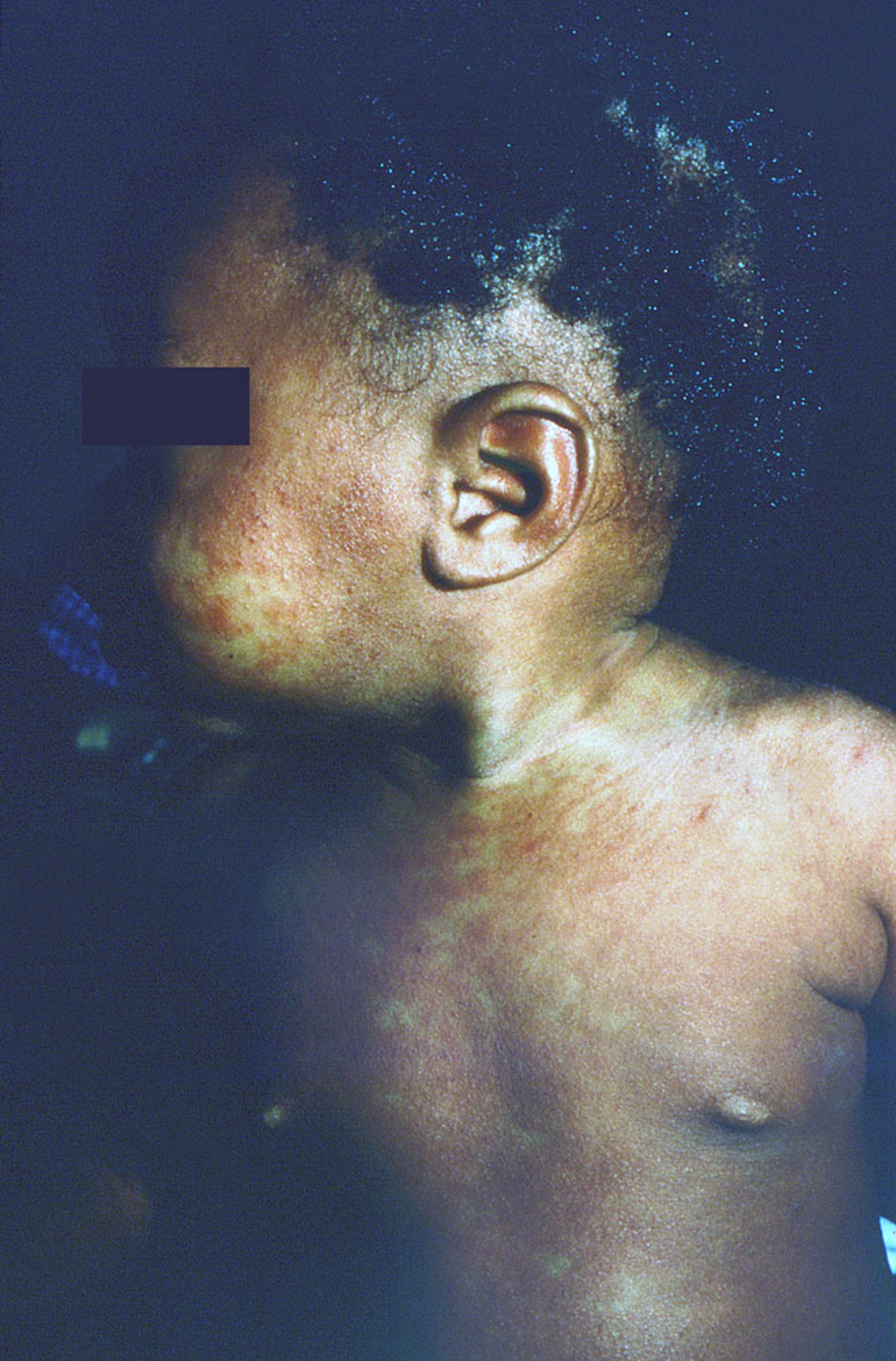 Macular Rash in Measles (3)