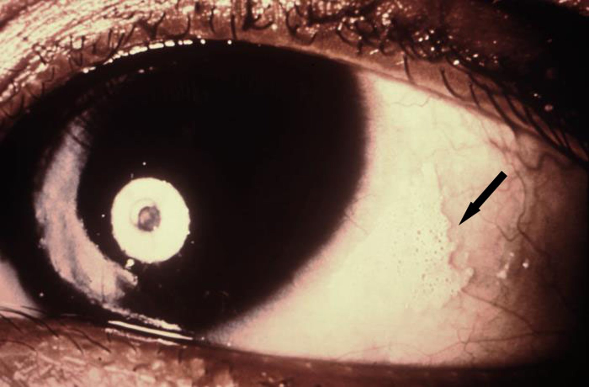 Xerophthalmia