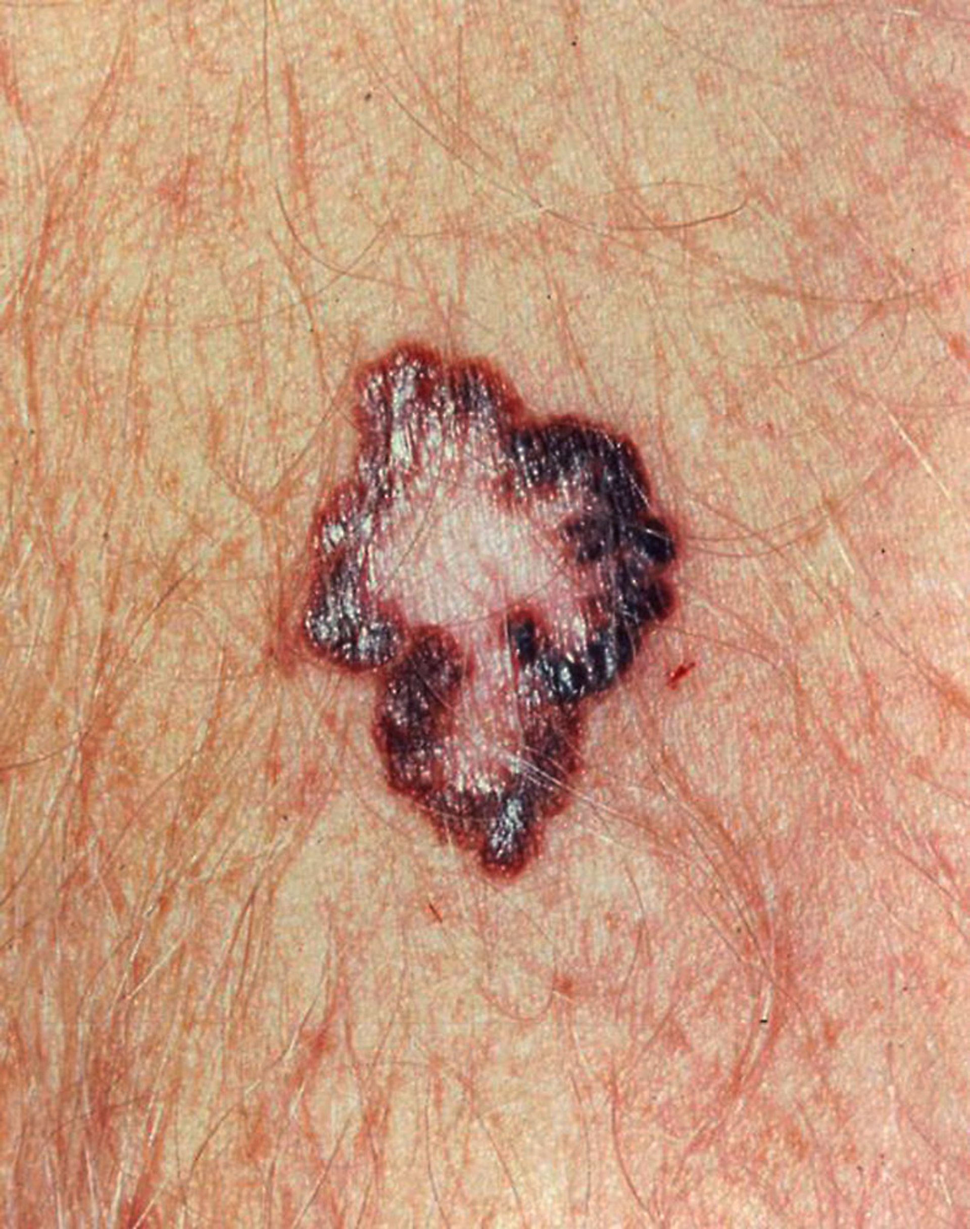 Cutaneous Pigmented Melanoma (1)
