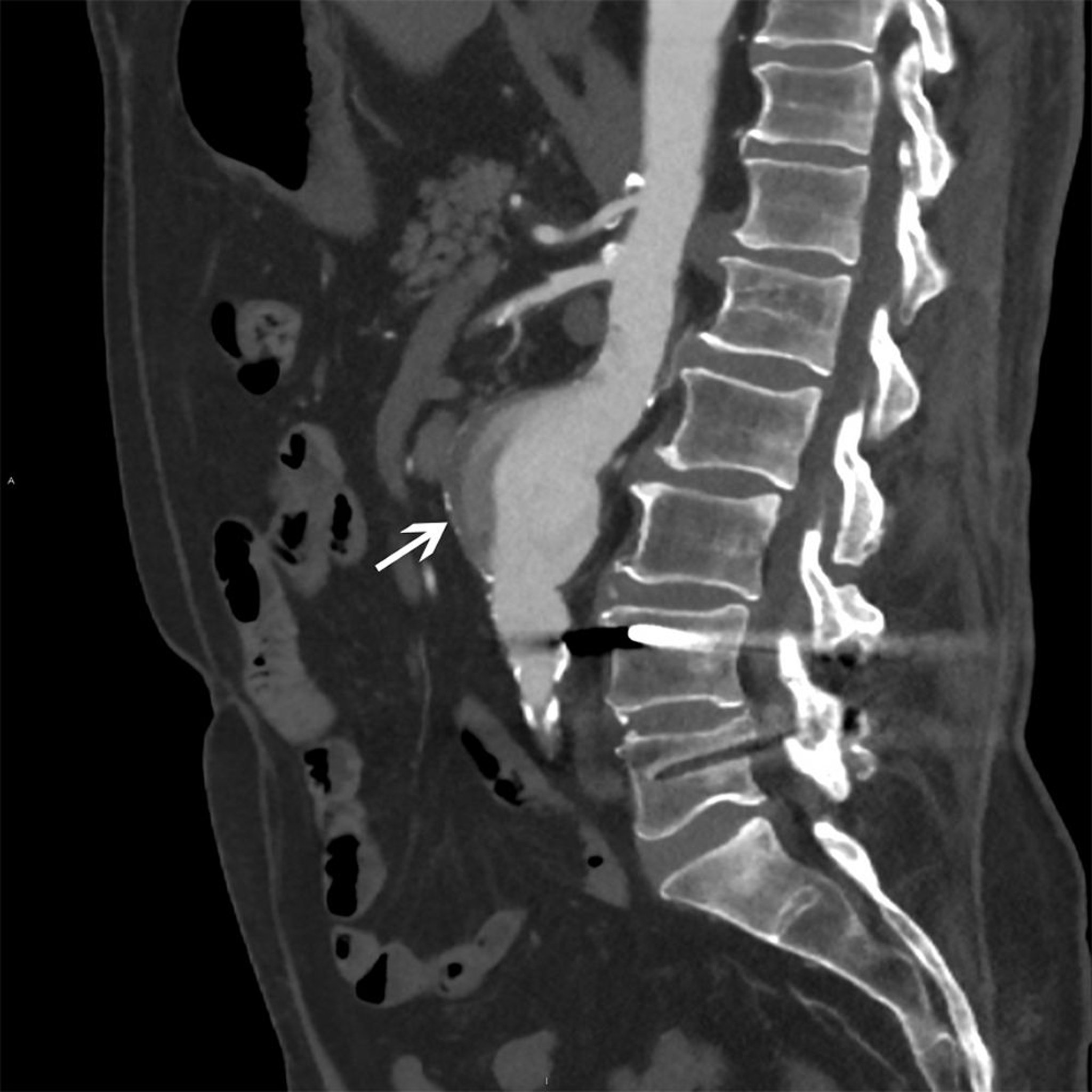 Bauchaortenaneurysma (CT)