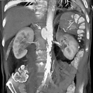 腹部大動脈の仮性動脈瘤（CT）
