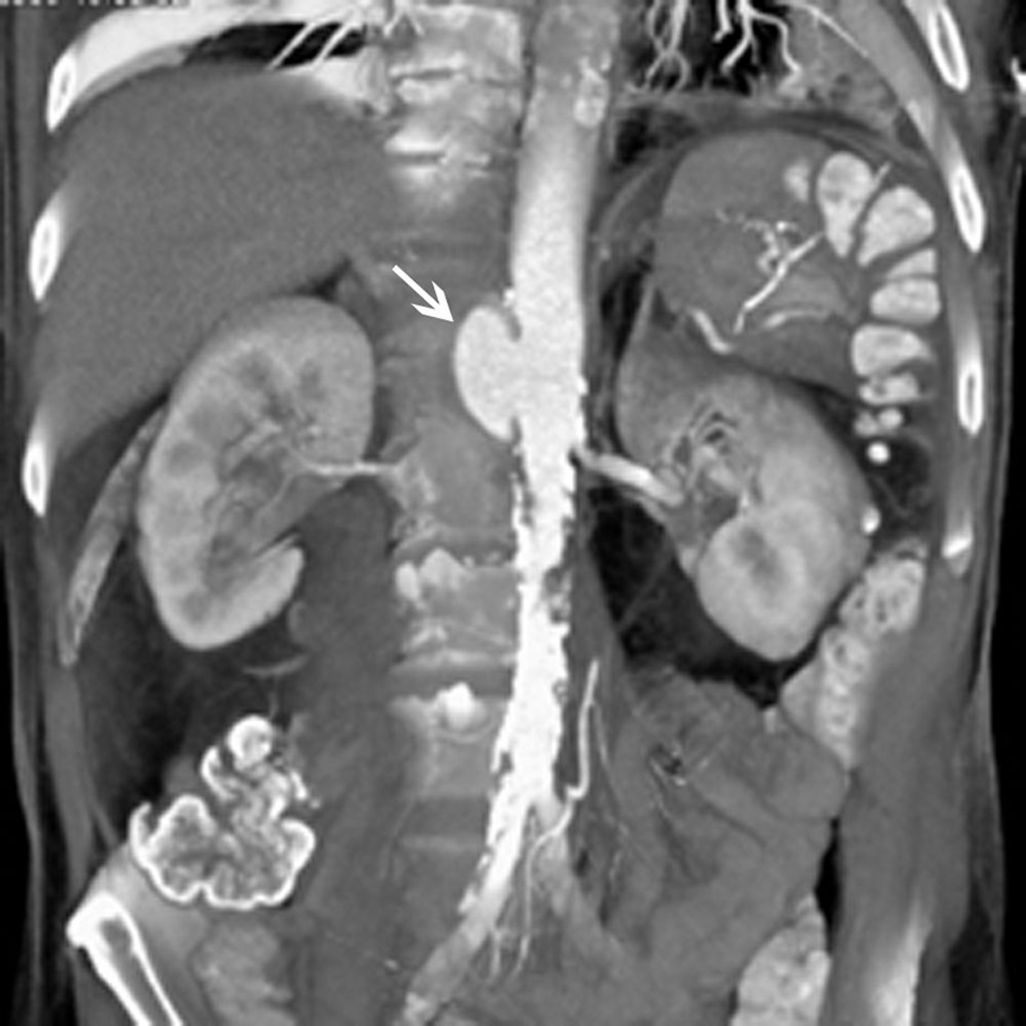 Pseudo-aneurisma da aorta abdominal (TC)