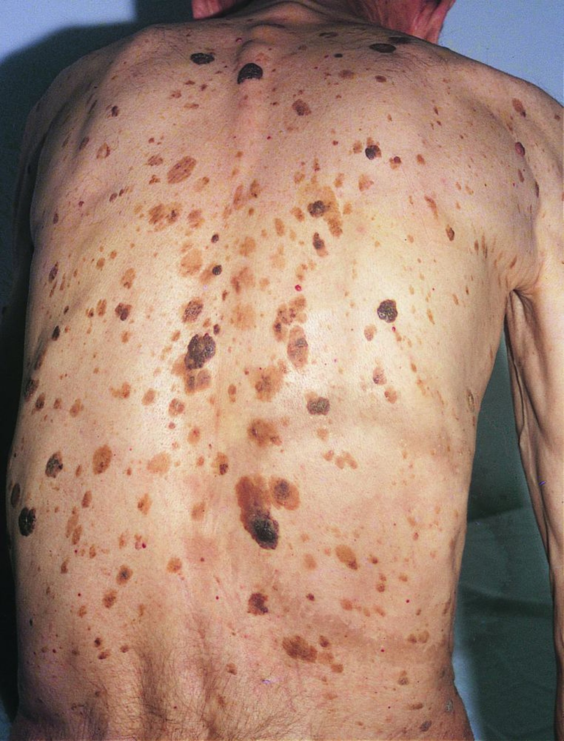 Sinal de Leser-Trélat